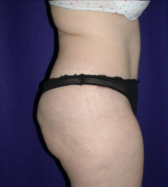 Tummy Tuck (abdominoplasty)