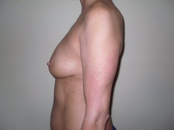 Breast Implants