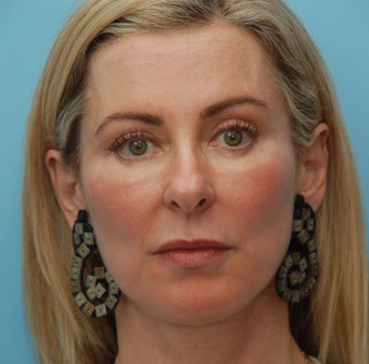 Under Eye Dermafiller, Cheek Dermafiller, Restylane