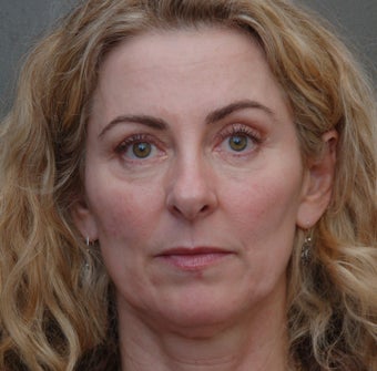 Under Eye Dermafiller, Cheek Dermafiller, Restylane