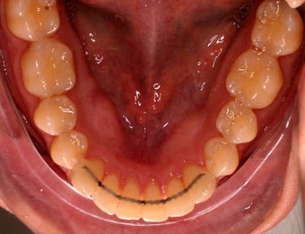 Invisalign