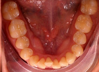 Invisalign