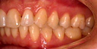 Invisalign