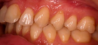 Invisalign