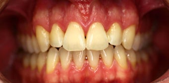 Invisalign