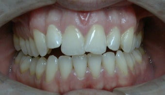 Invisalign