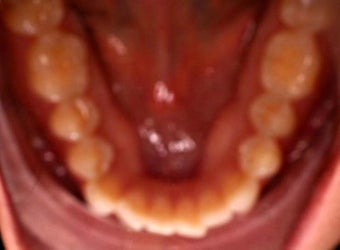 Invisalign