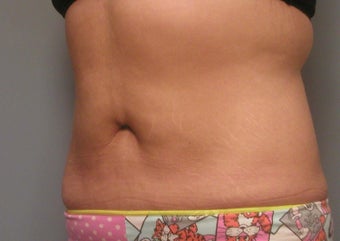 Body Jet and Slim Lipo