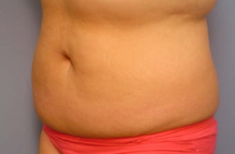 Body Jet and Slim Lipo