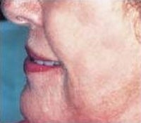 Skin Tightening
