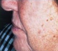 Skin Tightening