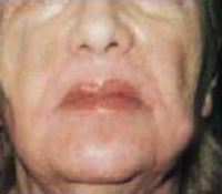 Skin Tightening