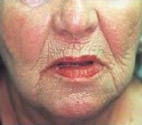 Skin Tightening
