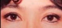 Blepharoplasty