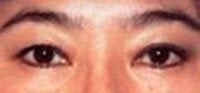 Blepharoplasty