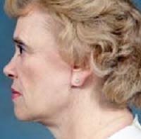 Facelift and Blepharoplasty