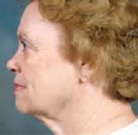 Facelift and Blepharoplasty