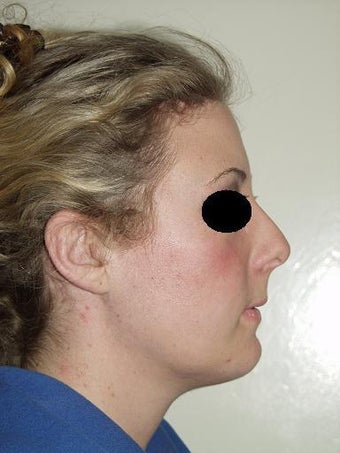 Chin implant