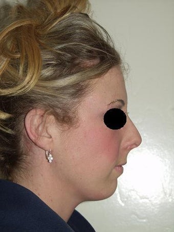 Chin implant