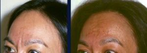 Forehead resection of the corrigator muscle