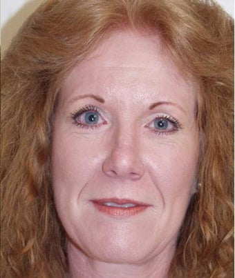 Facelift