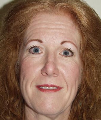 Facelift