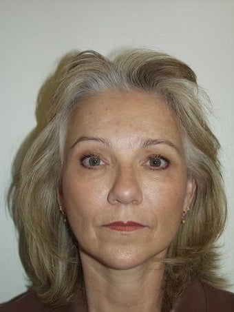 Facelift and Blepharoplasty