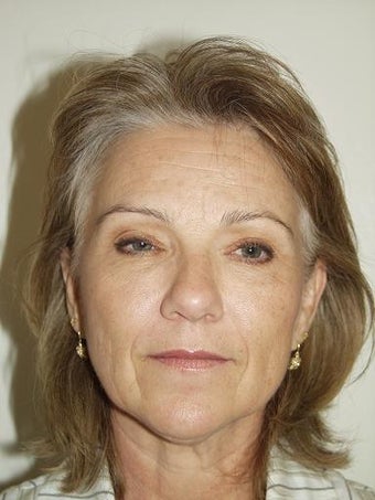 Facelift and Blepharoplasty