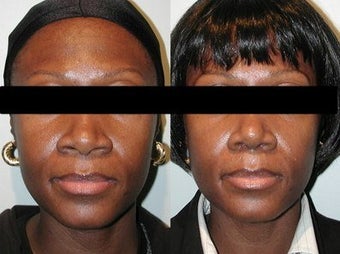 African American Rhinoplasty