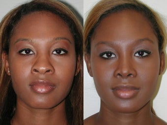 African American Rhinoplasty