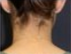 Otoplasty