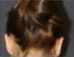 Otoplasty