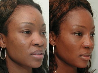 African American Rhinoplasty