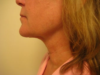 Laser Liposuction