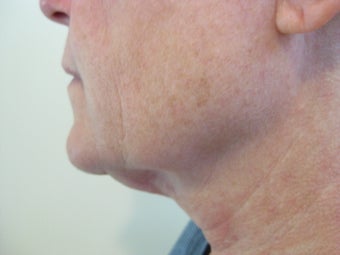 Laser Liposuction