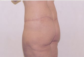 Body Lift