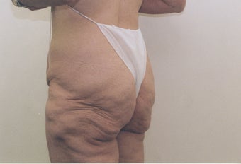 Body Lift