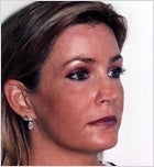 Upper and lowere eyelid surgery