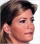 Upper and lowere eyelid surgery