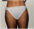 Liposuction
