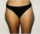Liposuction