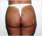 Liposuction