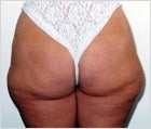 Liposuction