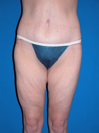 Body Lift