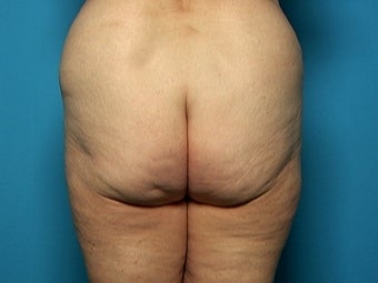 Buttock and Outer Thigh Lift