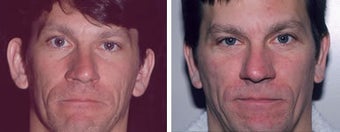 Otoplasty (ear surgery)