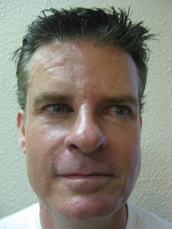 Laser Resurfacing