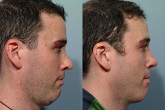 Revision rhinoplasty