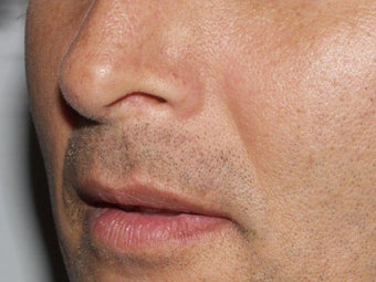 Lip Augmentation