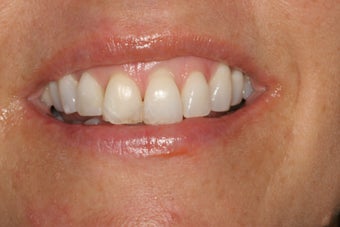 Gum Lift and Porcelain Veneers